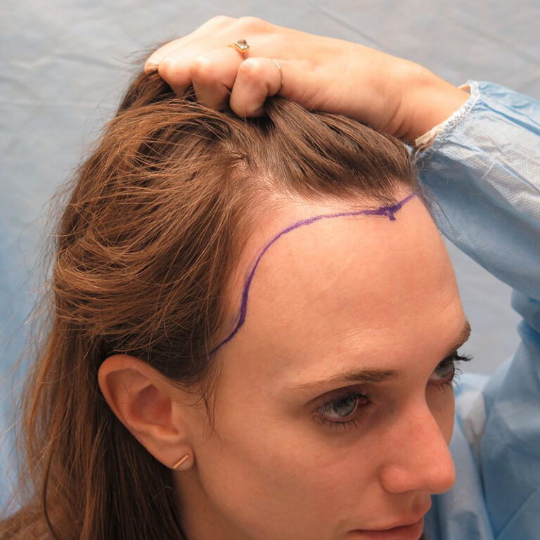 female hair transplant