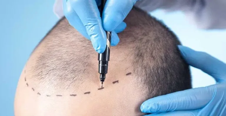 hair-transplant